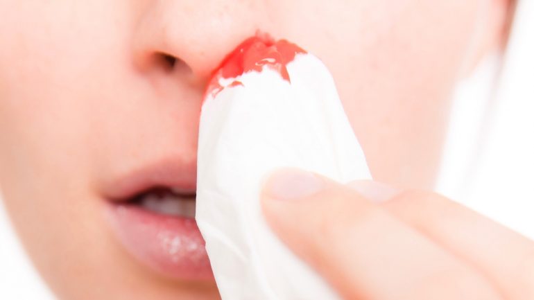 Cómo hacer sangrar tu nariz