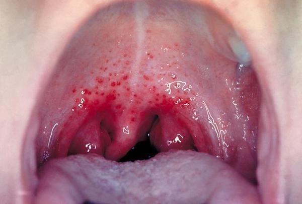 Dolor de garganta y lengua