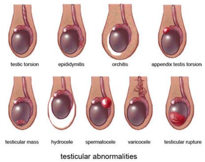Dolor en los testículos y el abdomen inferior
