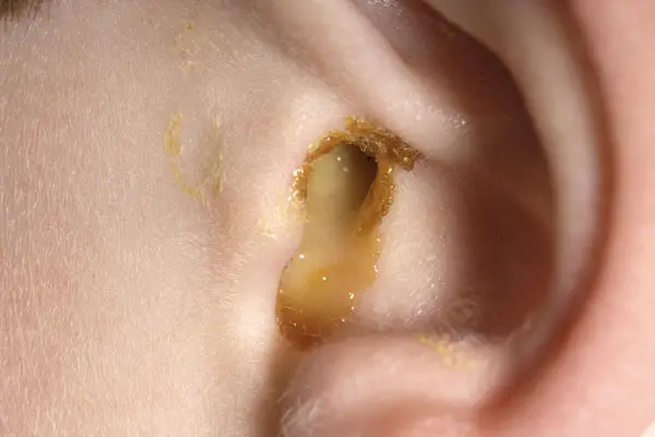 Drenaje de fluido del oído