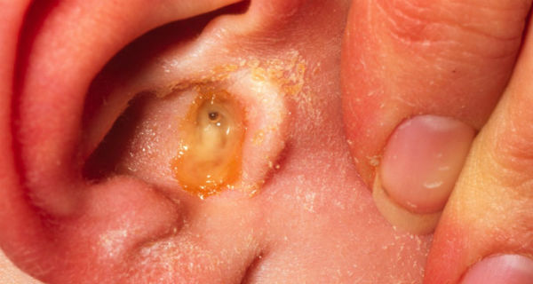 Infecciones de oído en adultos...