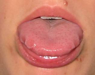 Marcas de dientes en la lengua