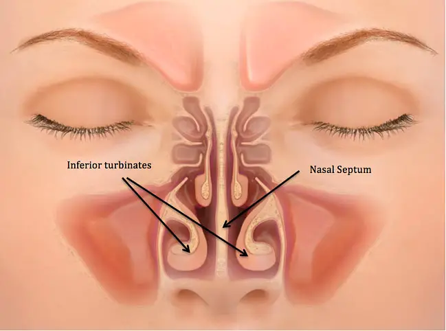 Perforación del tabique nasal