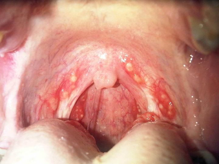 Qué aspecto tiene la faringitis estreptocócica