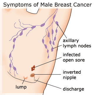 Síntomas del cáncer de mama en los hombres
