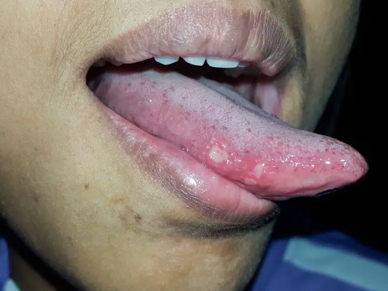 Blister de sangre en la lengua