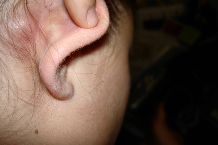 Doloroso bulto detrás de la oreja