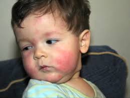 Pueden los bebés tener alergias estacionales