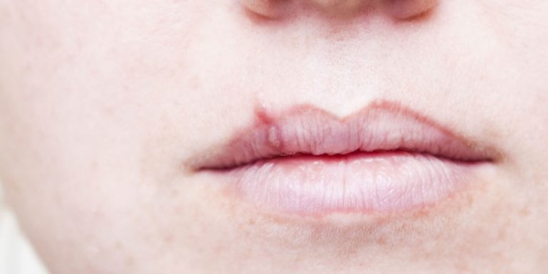 Qué tan comunes son los herpes labiales