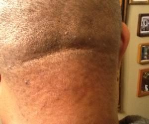 cómo deshacerse de los golpes de afeitar en la parte posterior de la cabeza