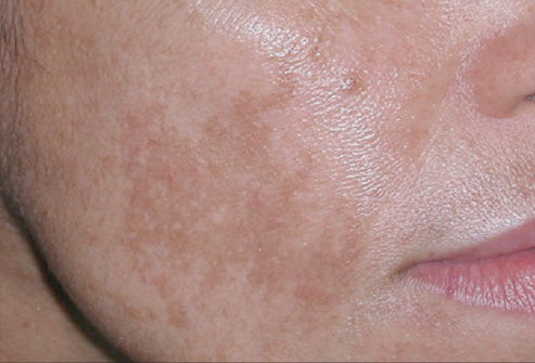 manchas marrones claras en la piel