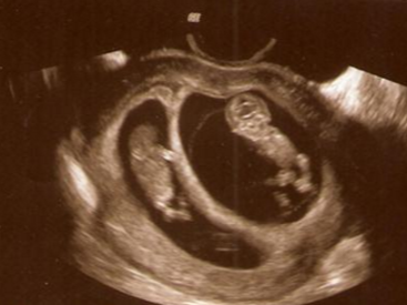 10 semanas de embarazo con gemelos
