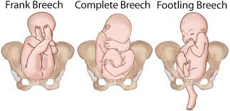 Defectos de nacimiento del bebé de nalgas
