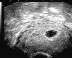 Imágenes de ultrasonido de 5 semanas