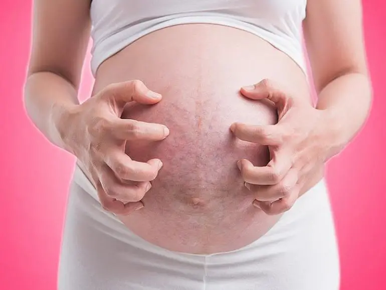 Prurito durante el embarazo