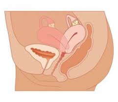 embarazo inclinado del útero
