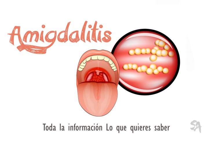 amigdalitis