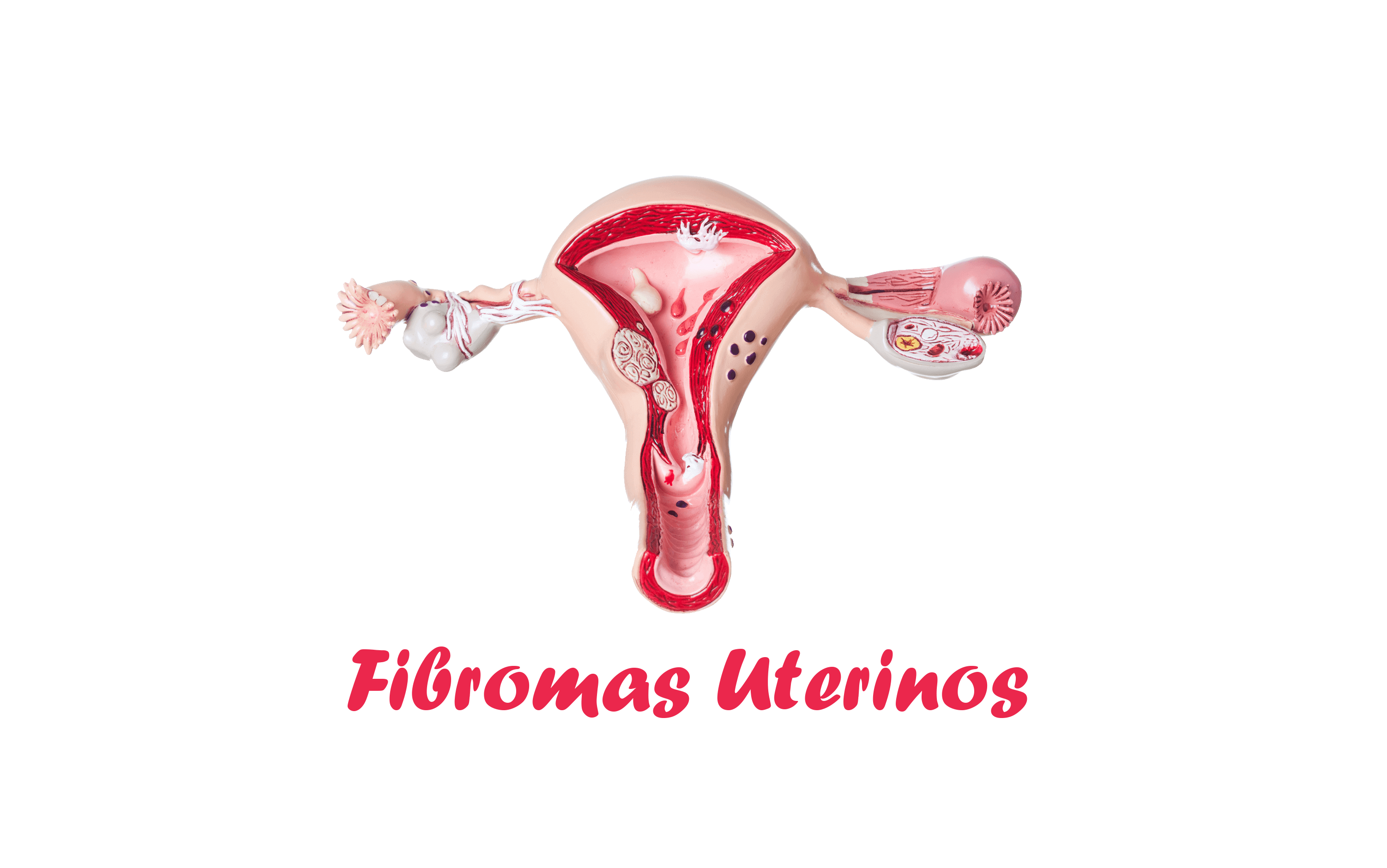 Fibromas Uterinos