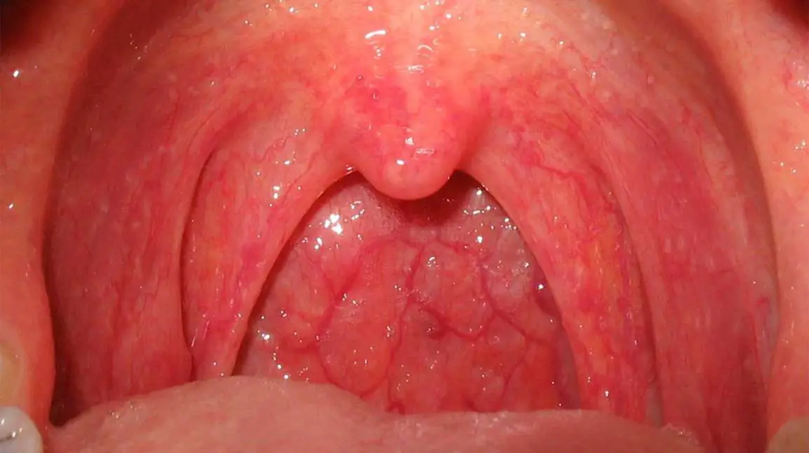 Parte posterior de la garganta