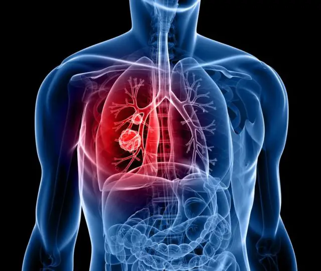 cancer de pulmon en estadio 4