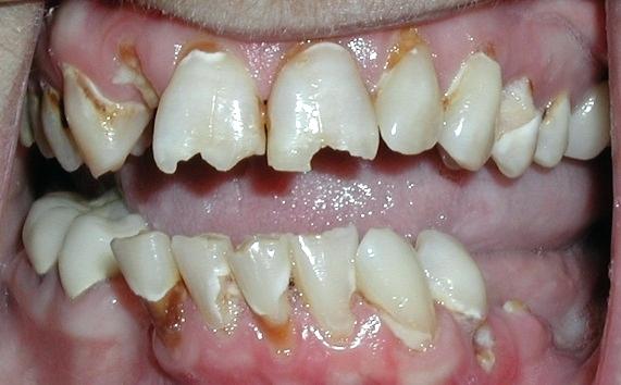 Cambio en el tamaño del diente